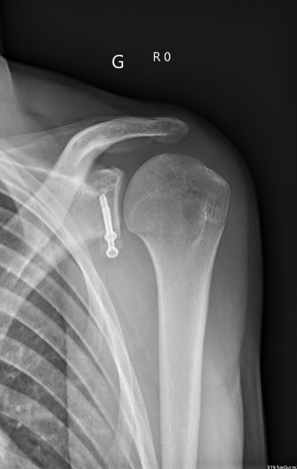 Schéma de fixation de la butée par vis