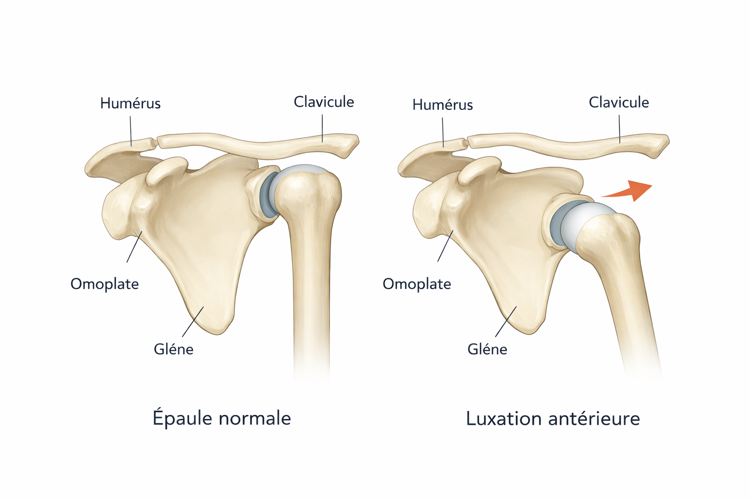 Schéma comparatif : épaule normale vs luxation antérieure (tête humérale sortie en avant)
