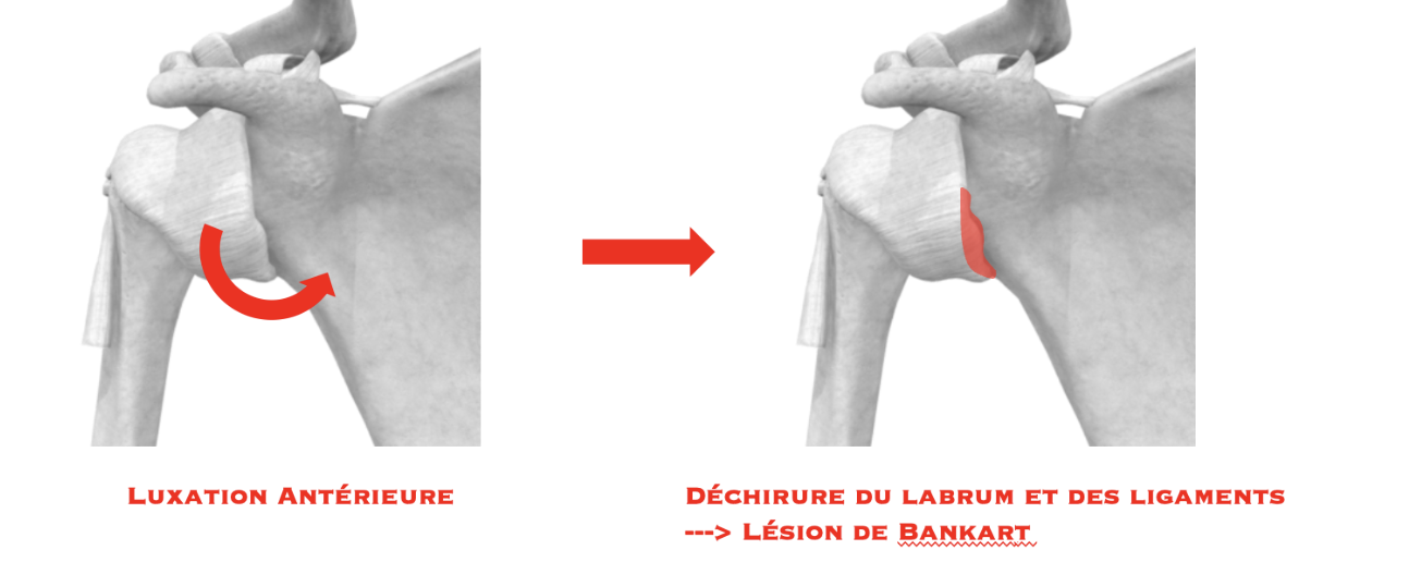 Lésion de Bankart