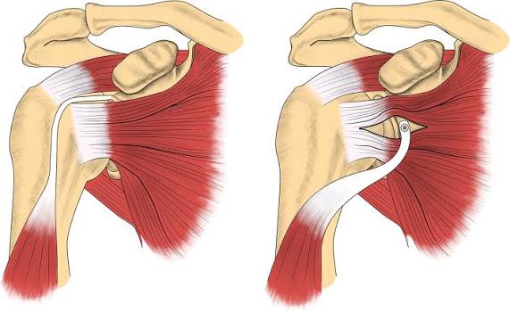 Dynamic Anterior Stabilization — transfert du tendon du biceps
